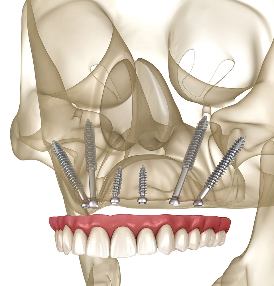 Pterygoid implants