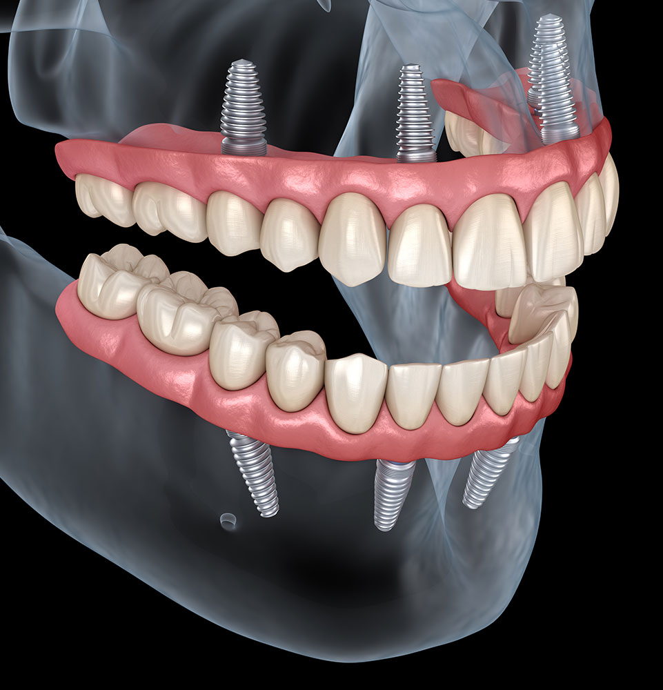 all on 4 precise implant placement