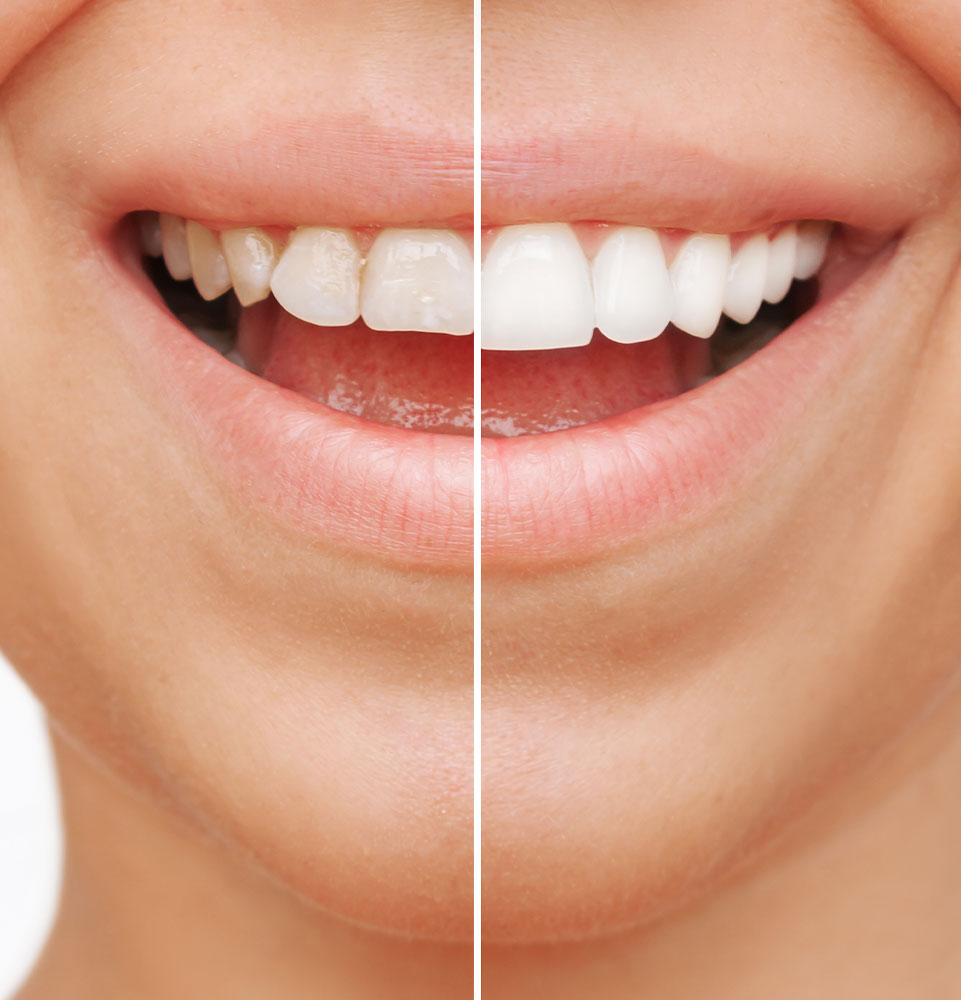 before and after implant