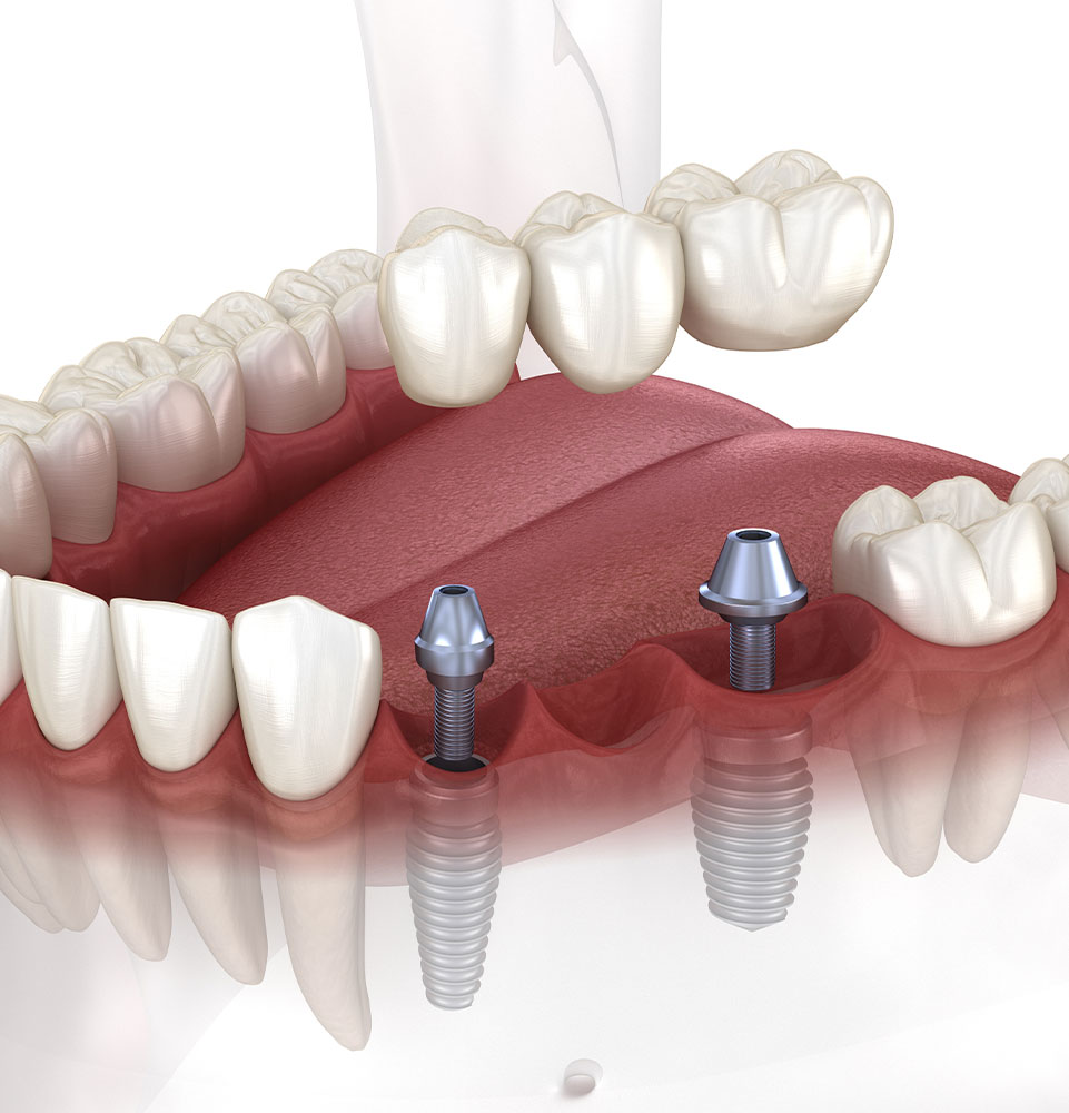 dental bridge
