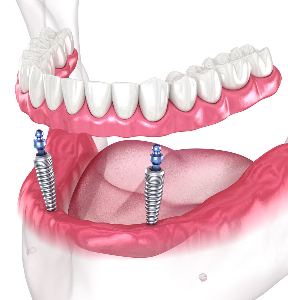 denture timeline flip