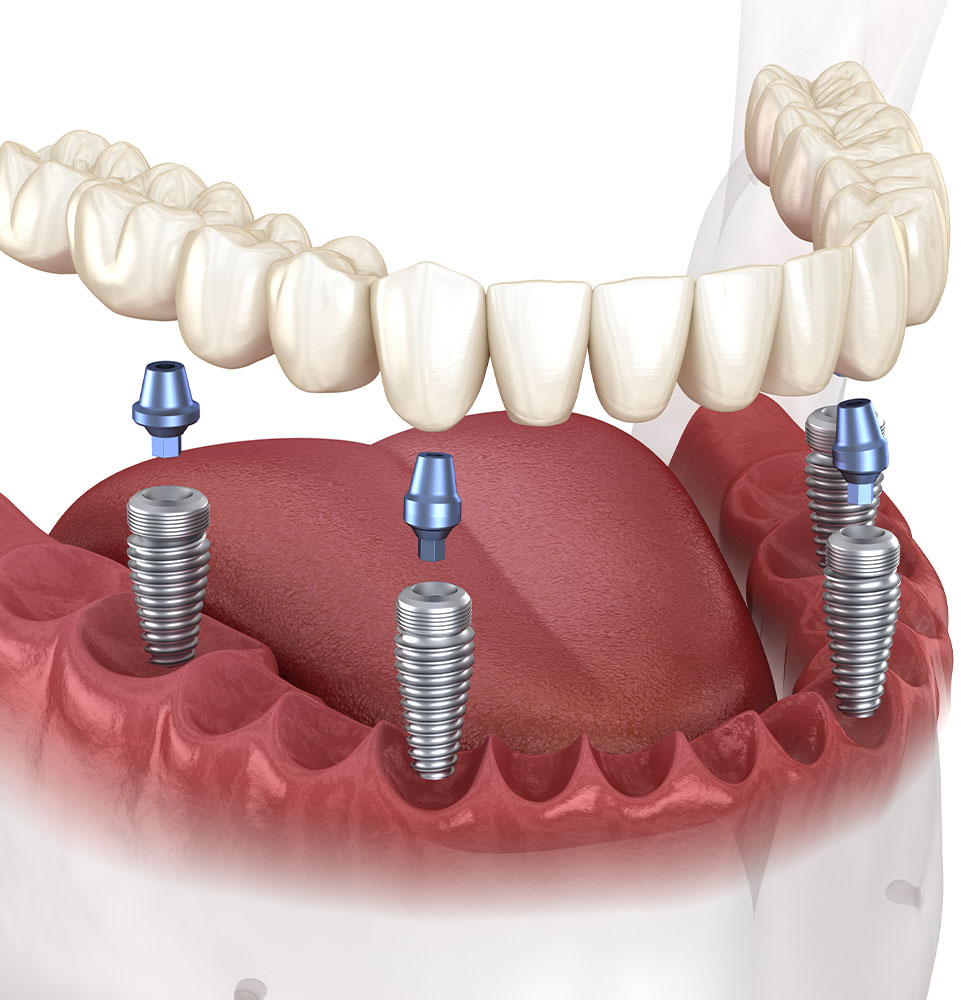 full mouth implants