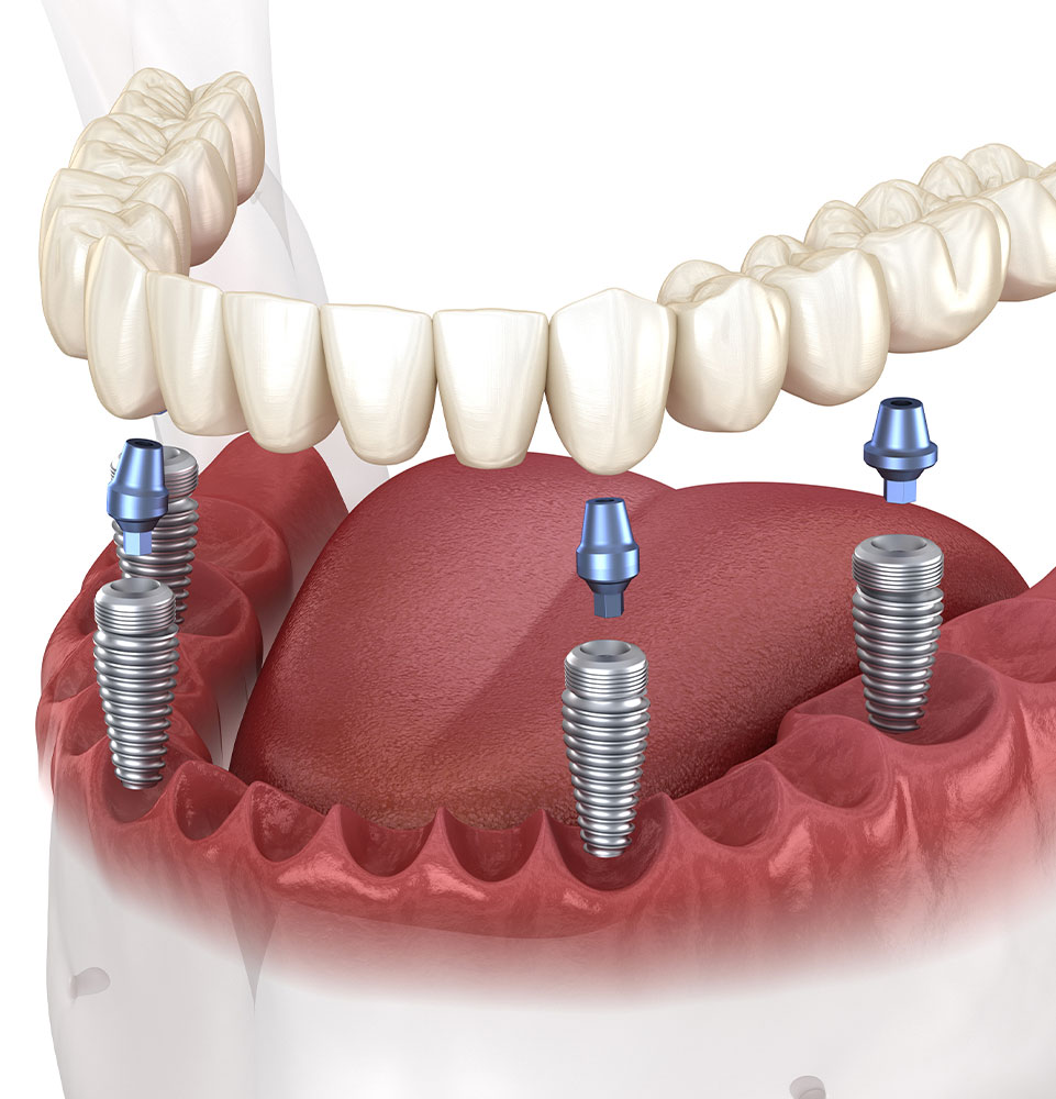 full mouth implants