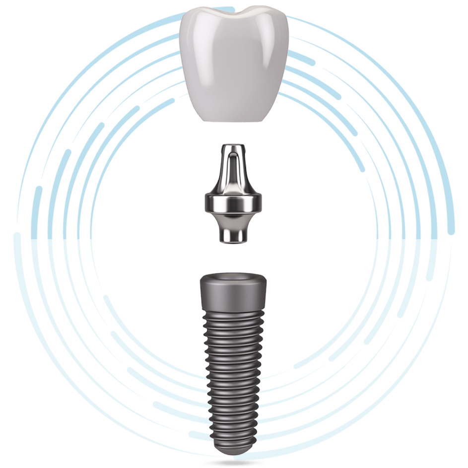 implant anchor stylized
