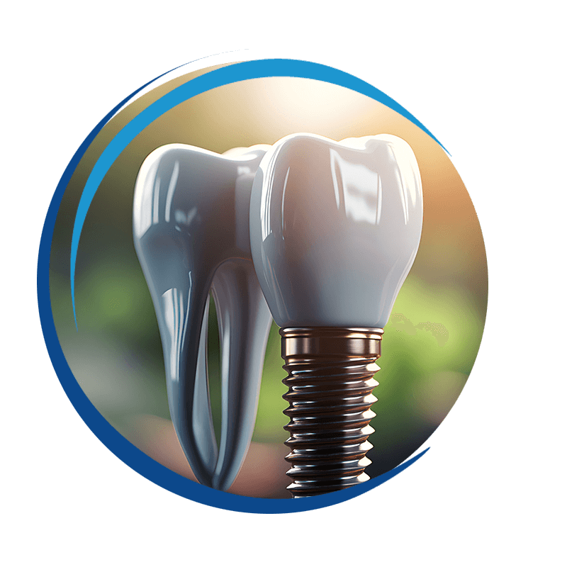 implant model 3d