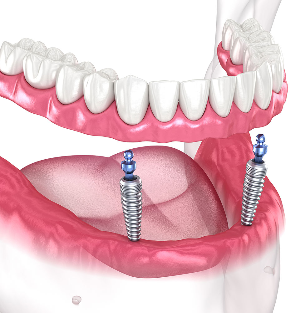 implant supported denture