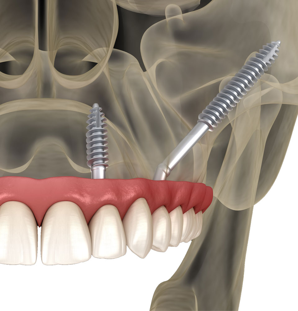 zygomatic