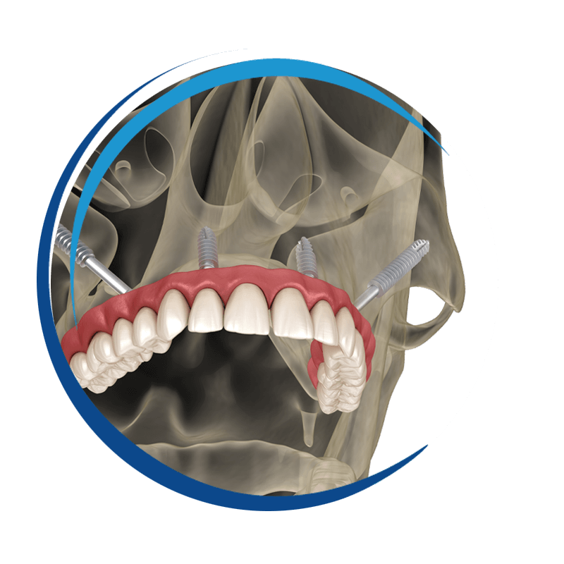 zygomatic 3d styled