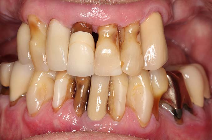 full arch dental implant case 12 before