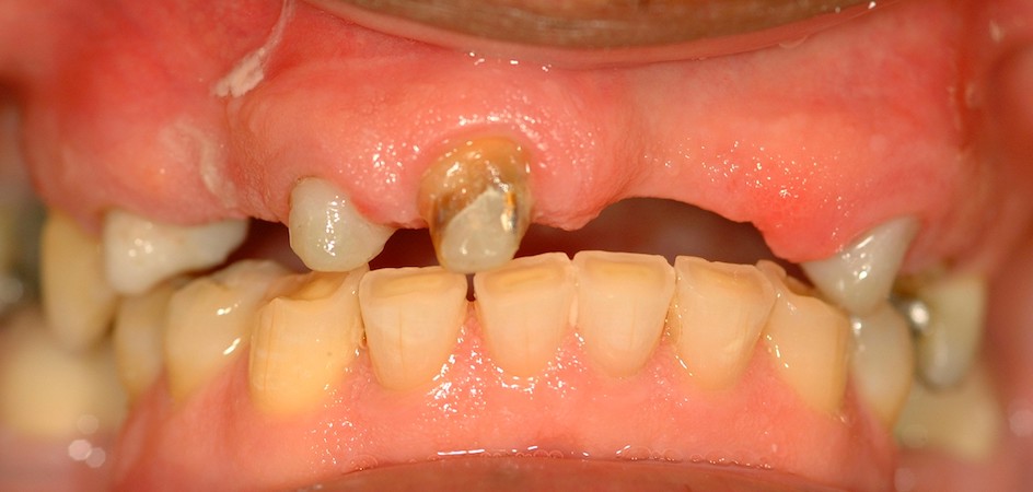 full arch dental implant case 2 before