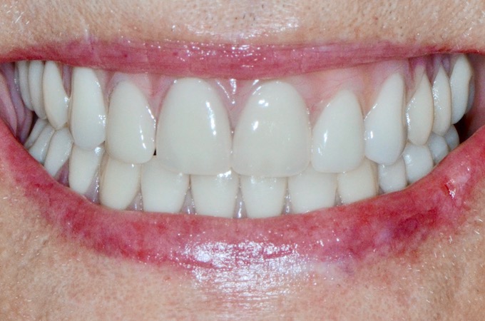 full arch dental implant case 12 after