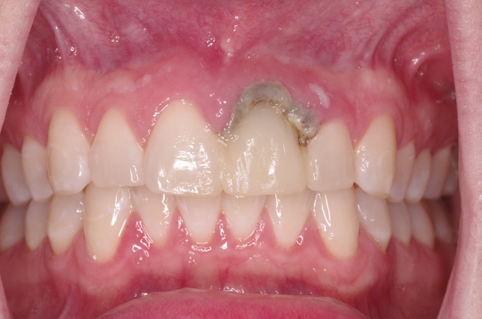 full arch dental implant case 5 before