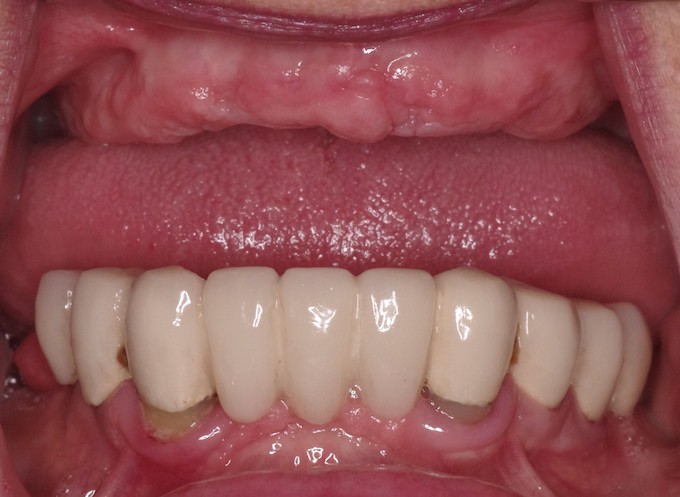 full arch dental implant case 7 before