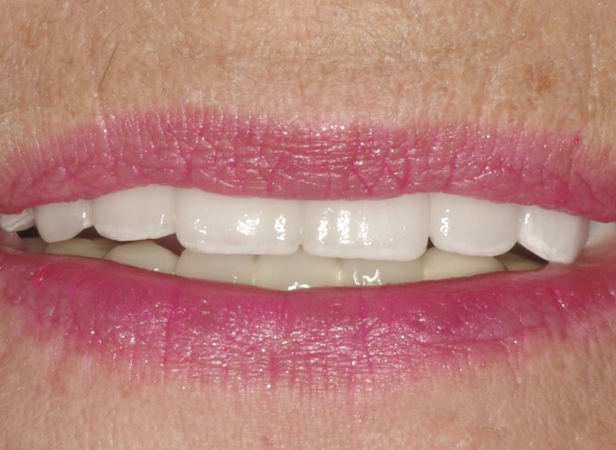 full arch dental implant case 7 after