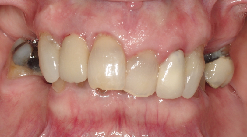 full arch dental implant case 4 before