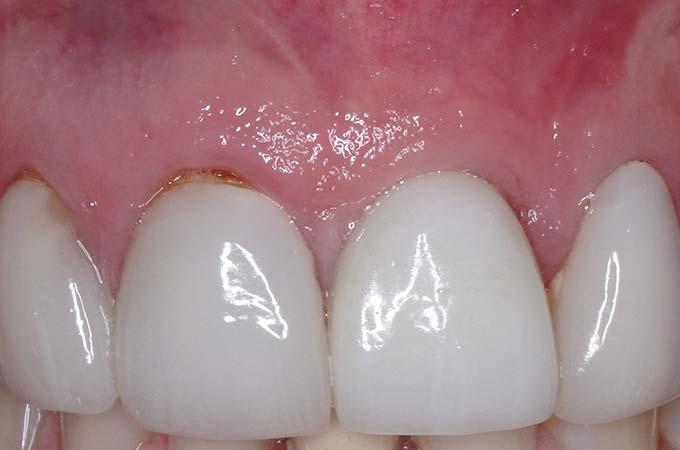 full arch dental implant case 8 after