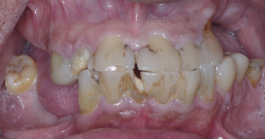 full arch dental implant case 3 before