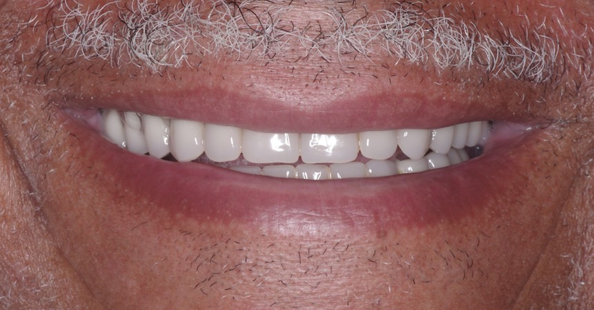 full arch dental implant case 3 after