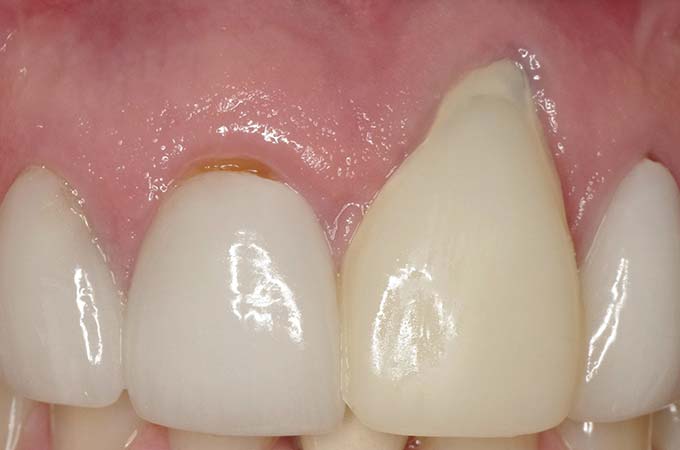 full arch dental implant case 8 before