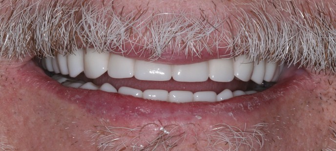 full arch dental implant case 6 after
