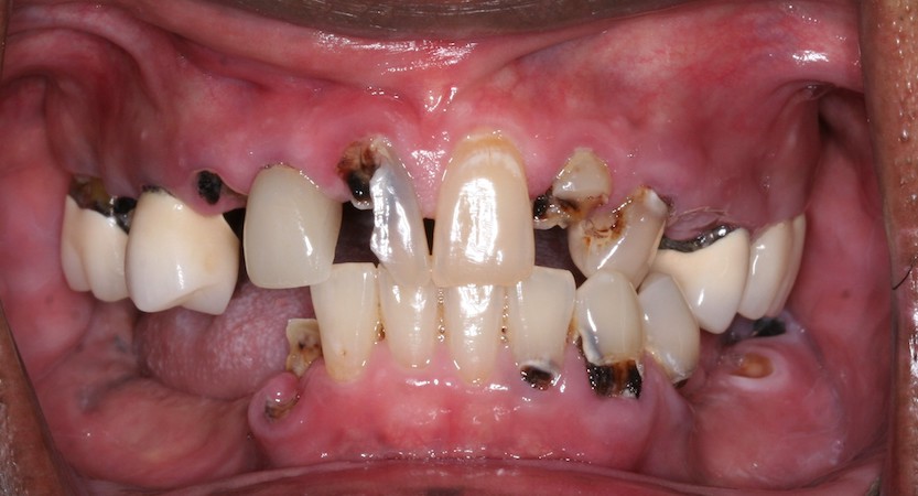 full arch dental implant case 1 before