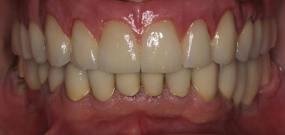 full arch dental implant case 2 after