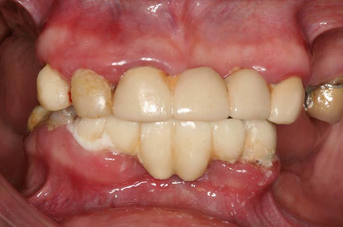 full arch dental implant case 9 before