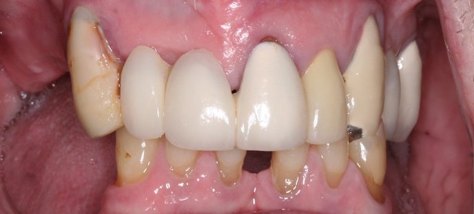 full arch dental implant case 6 before