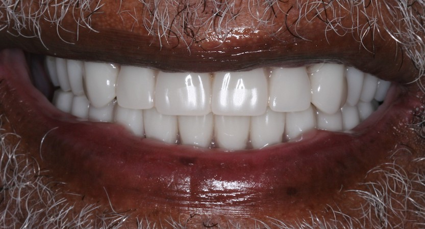 full arch dental implant case 1 after