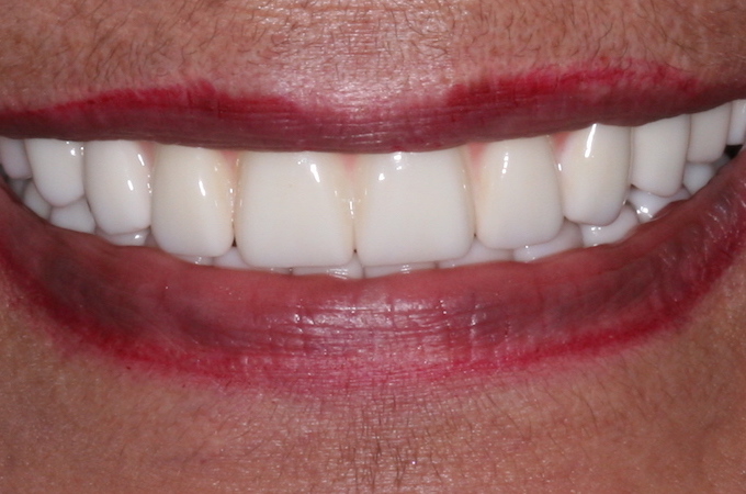 full arch dental implant case 9 after