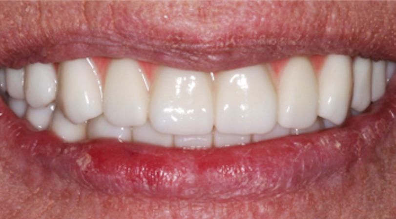 full arch dental implant case 4 after