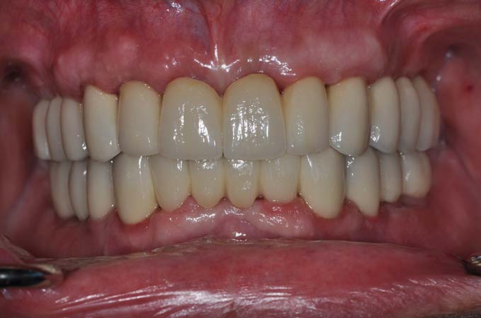 full arch dental implant case 10 after