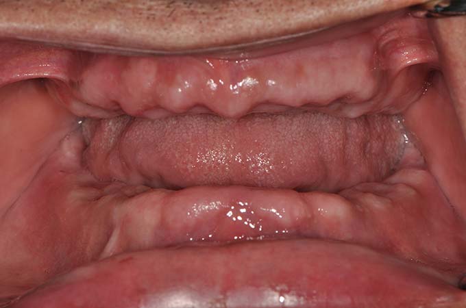 full arch dental implant case 11 before