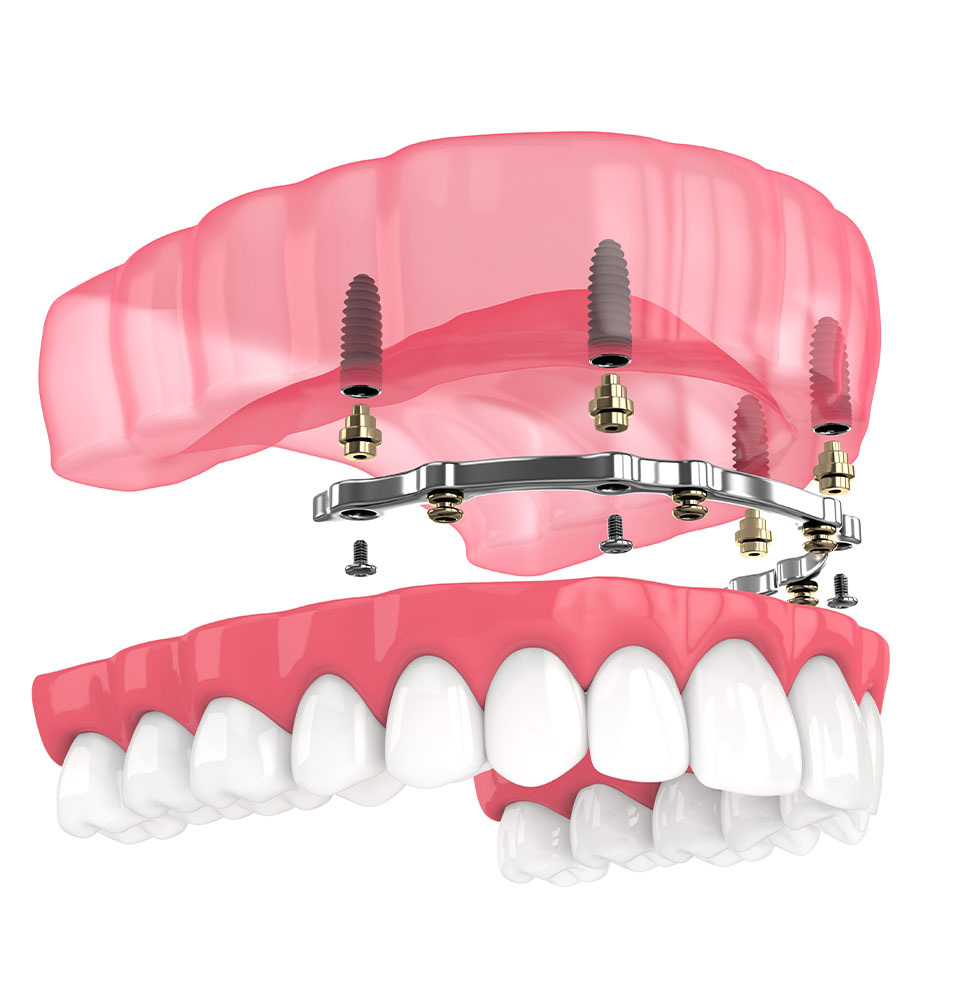 full arch implant illustration